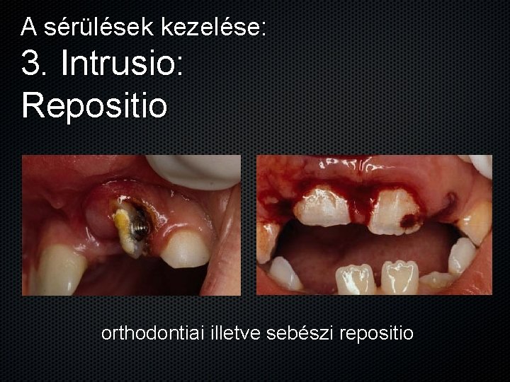 A sérülések kezelése: 3. Intrusio: Repositio orthodontiai illetve sebészi repositio 
