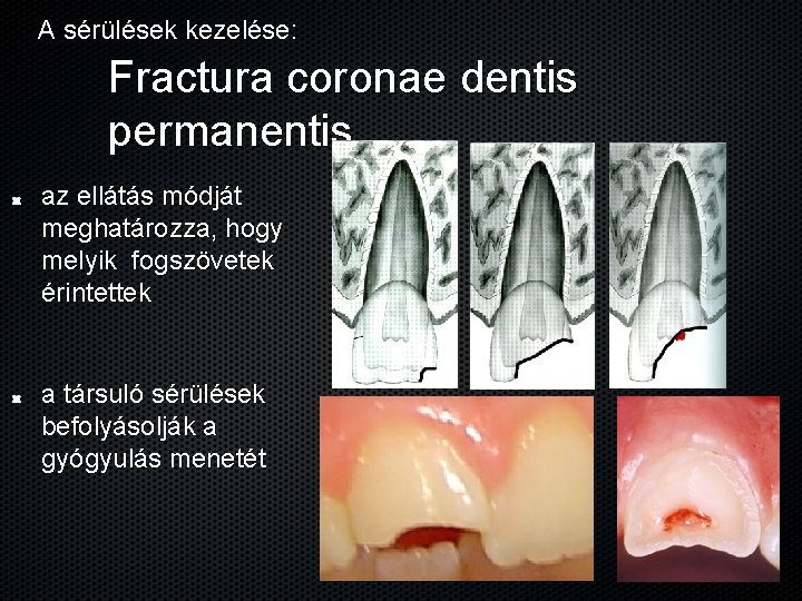 A sérülések kezelése: Fractura coronae dentis permanentis az ellátás módját meghatározza, hogy melyik fogszövetek