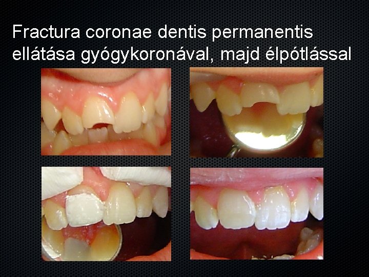 Fractura coronae dentis permanentis ellátása gyógykoronával, majd élpótlással 