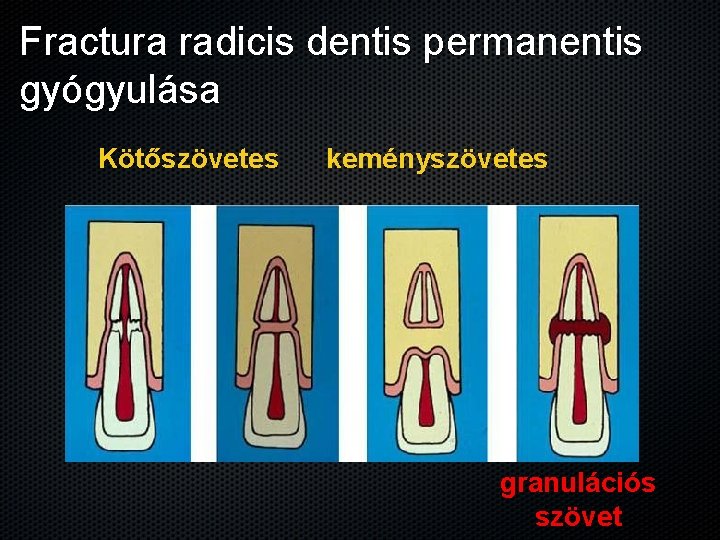 Fractura radicis dentis permanentis gyógyulása Kötőszövetes keményszövetes granulációs szövet 