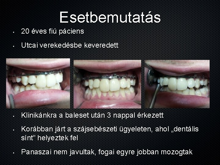 Esetbemutatás • 20 éves fiú páciens • Utcai verekedésbe keveredett • Klinikánkra a baleset