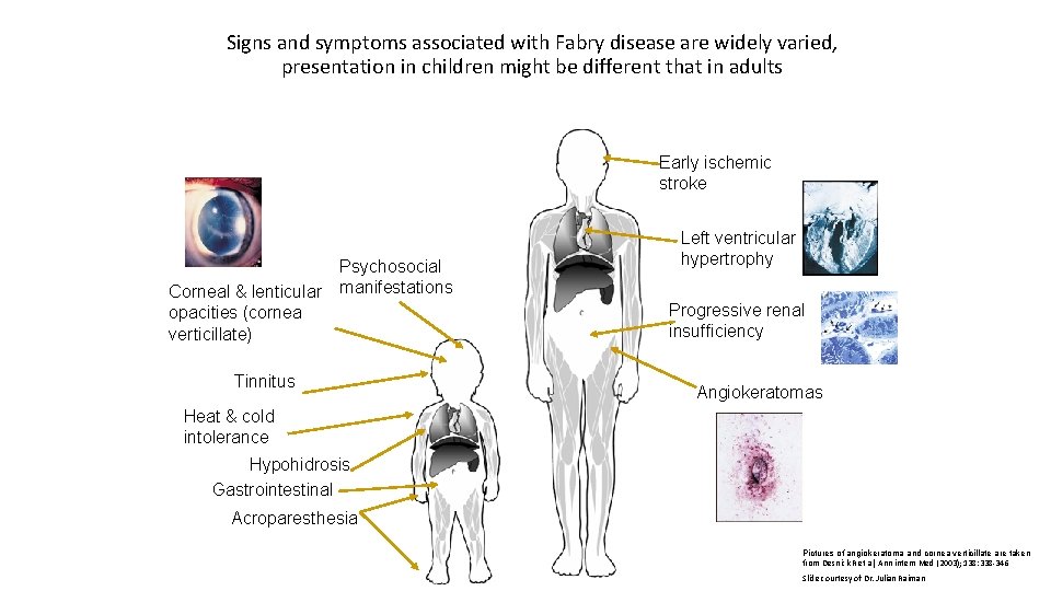 Signs and symptoms associated with Fabry disease are widely varied, presentation in children might