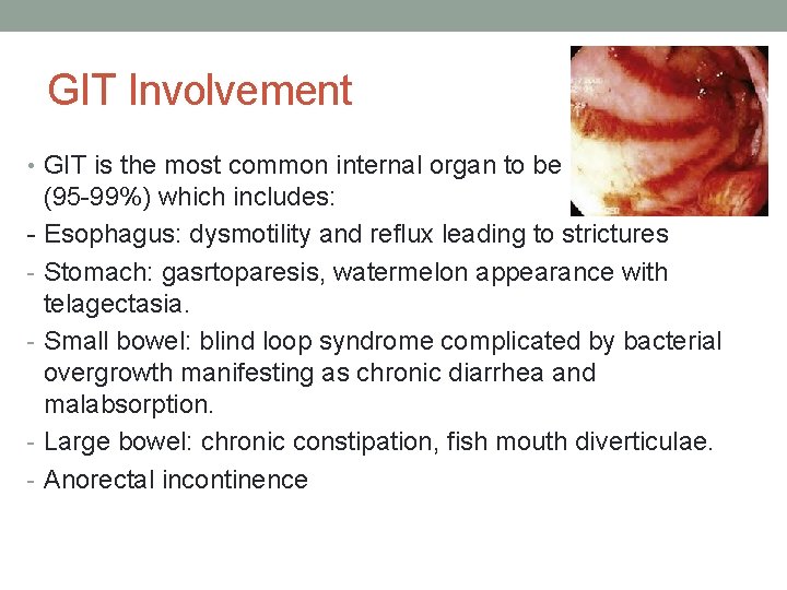 GIT Involvement • GIT is the most common internal organ to be involved (95