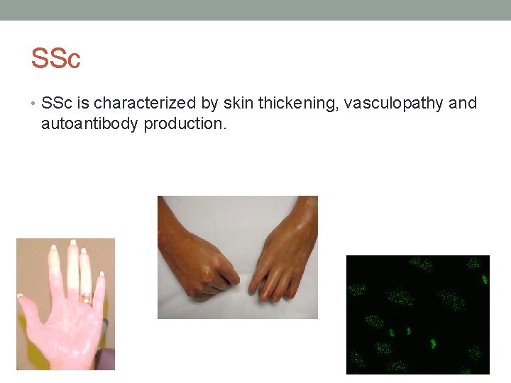 SSc • SSc is characterized by skin thickening, vasculopathy and autoantibody production. 