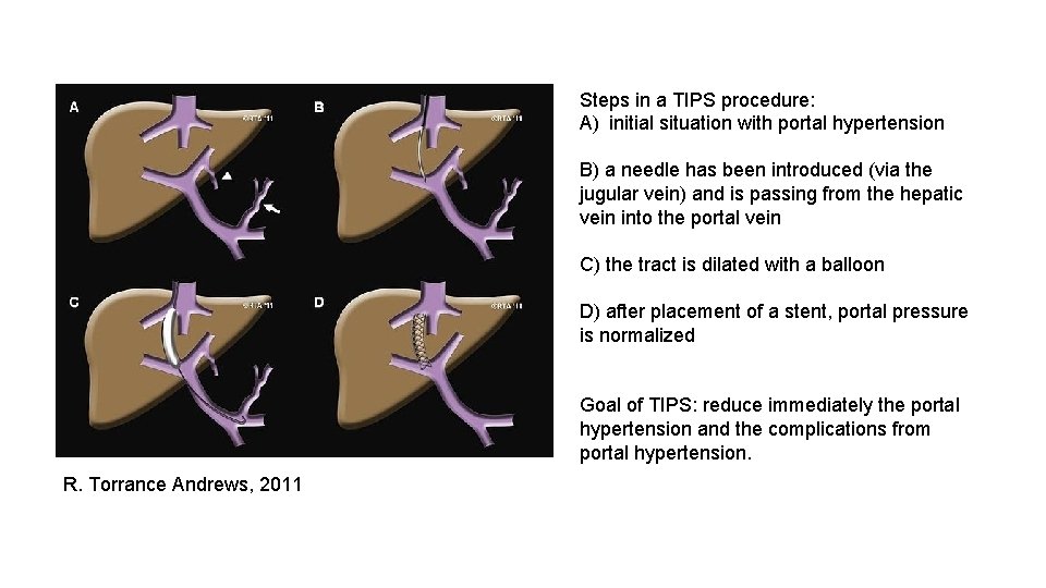 Steps in a TIPS procedure: A) initial situation with portal hypertension B) a needle