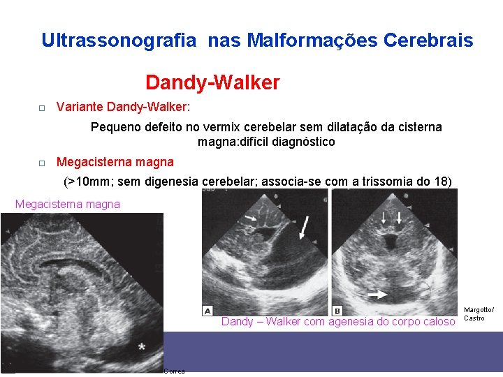 Ultrassonografia nas Malformações Cerebrais Dandy-Walker Variante Dandy-Walker: Pequeno defeito no vermix cerebelar sem dilatação