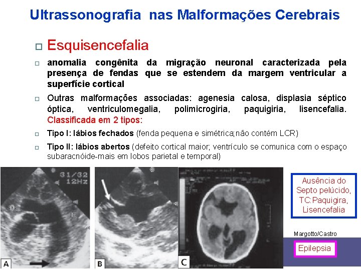 Ultrassonografia nas Malformações Cerebrais Esquisencefalia anomalia congênita da migração neuronal caracterizada pela presença de