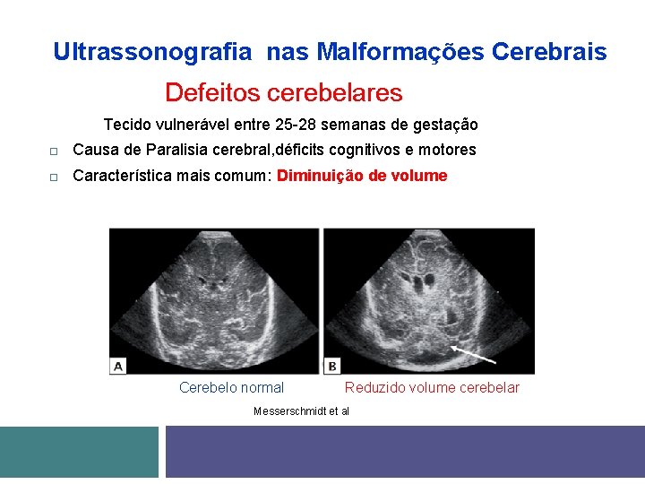 Ultrassonografia nas Malformações Cerebrais Defeitos cerebelares Tecido vulnerável entre 25 -28 semanas de gestação