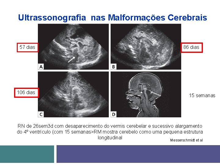 Ultrassonografia nas Malformações Cerebrais 57 dias 106 dias 86 dias 15 semanas RN de