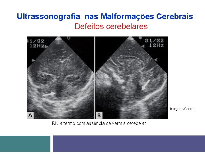 Ultrassonografia nas Malformações Cerebrais Defeitos cerebelares Margotto/Castro RN a termo com ausência de vermis