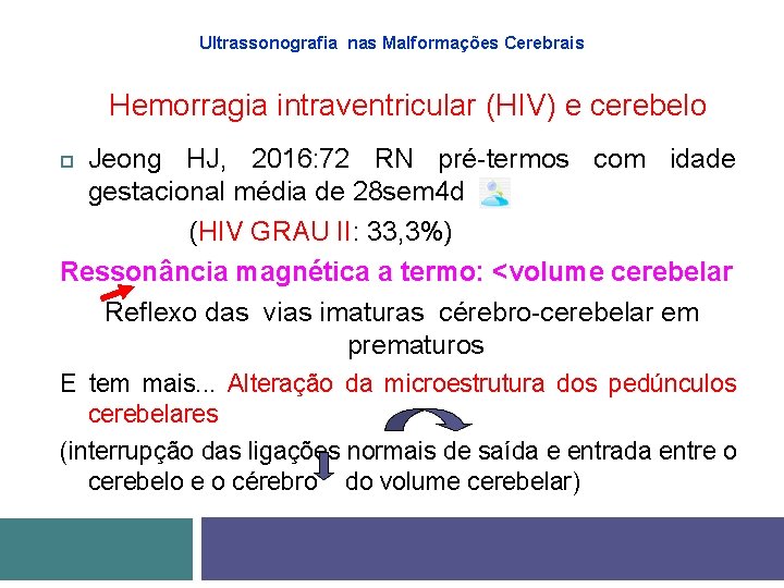 Ultrassonografia nas Malformações Cerebrais Hemorragia intraventricular (HIV) e cerebelo Jeong HJ, 2016: 72 RN