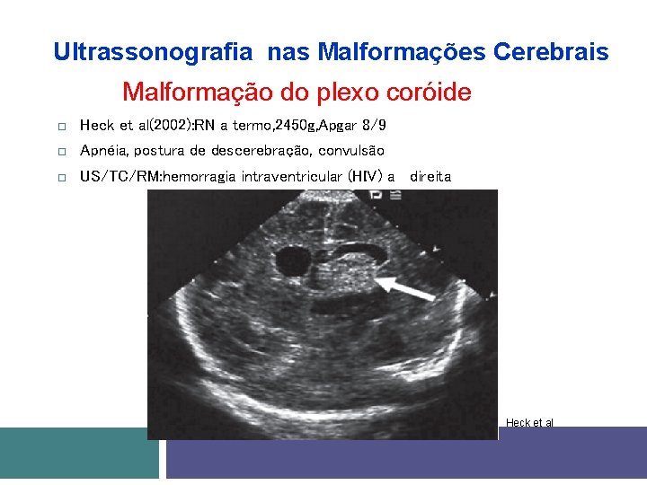 Ultrassonografia nas Malformações Cerebrais Malformação do plexo coróide Heck et al(2002): RN a termo,