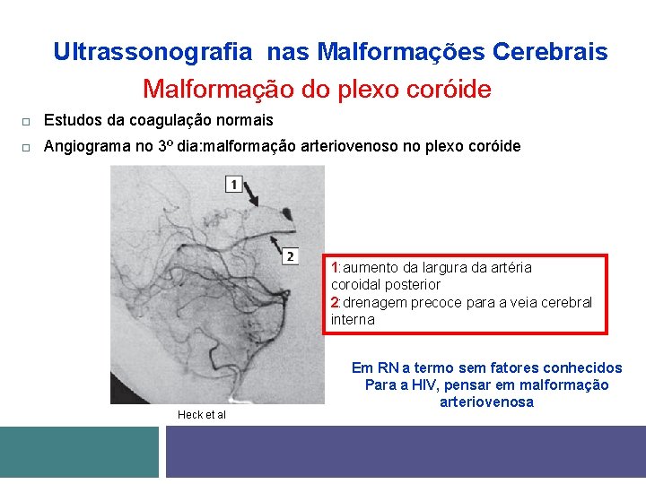 Ultrassonografia nas Malformações Cerebrais Malformação do plexo coróide Estudos da coagulação normais Angiograma no