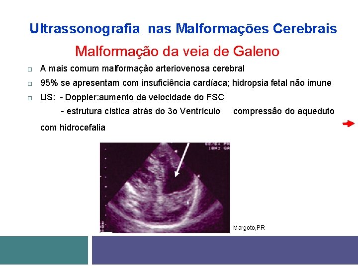 Ultrassonografia nas Malformações Cerebrais Malformação da veia de Galeno A mais comum malformação arteriovenosa