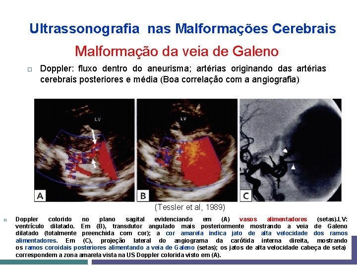 Ultrassonografia nas Malformações Cerebrais Malformação da veia de Galeno Doppler: fluxo dentro do aneurisma;