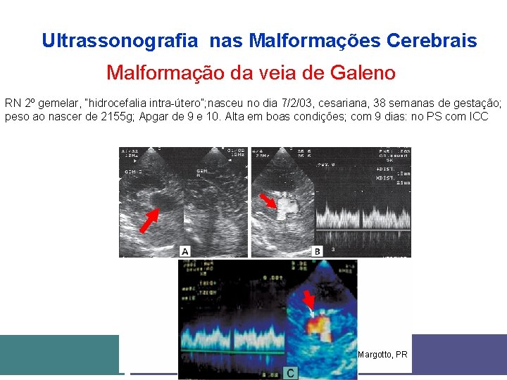 Ultrassonografia nas Malformações Cerebrais Malformação da veia de Galeno RN 2º gemelar, “hidrocefalia intra-útero”;