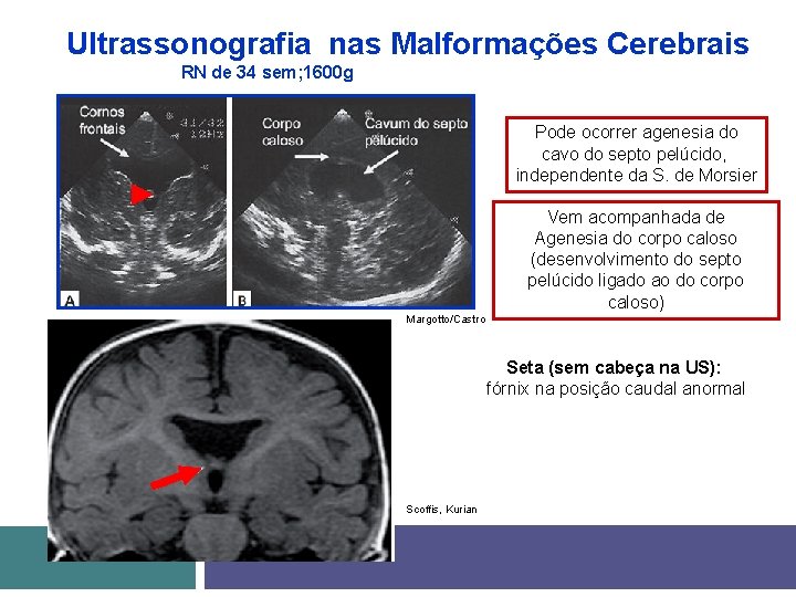 Ultrassonografia nas Malformações Cerebrais RN de 34 sem; 1600 g Pode ocorrer agenesia do