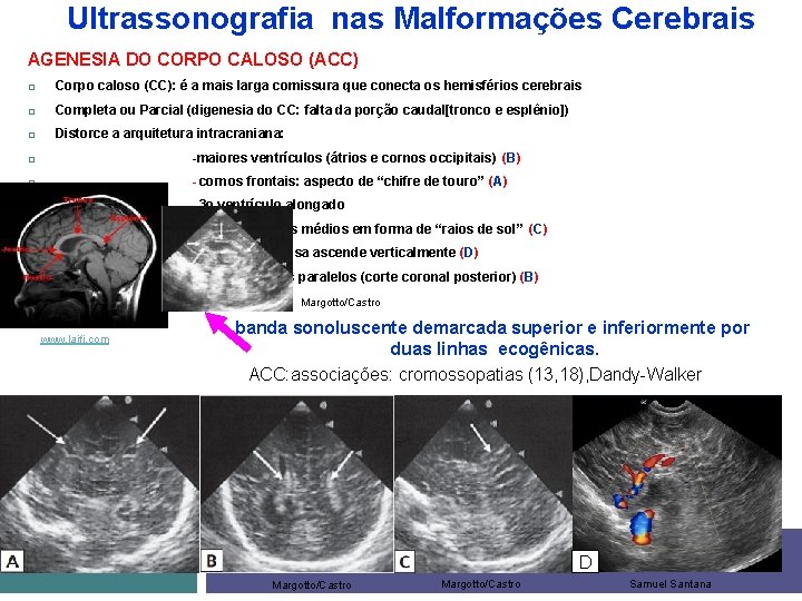 Ultrassonografia nas Malformações Cerebrais AGENESIA DO CORPO CALOSO (ACC) Corpo caloso (CC): é a