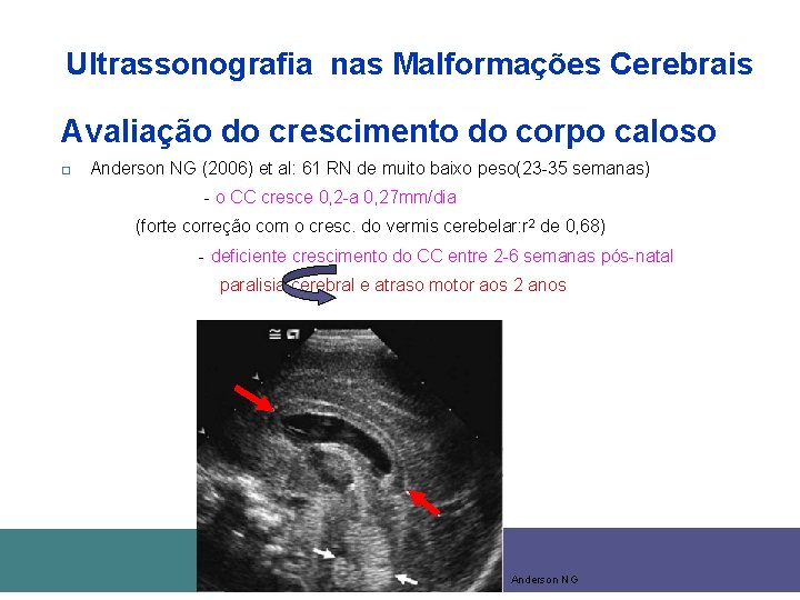 Ultrassonografia nas Malformações Cerebrais Avaliação do crescimento do corpo caloso Anderson NG (2006) et