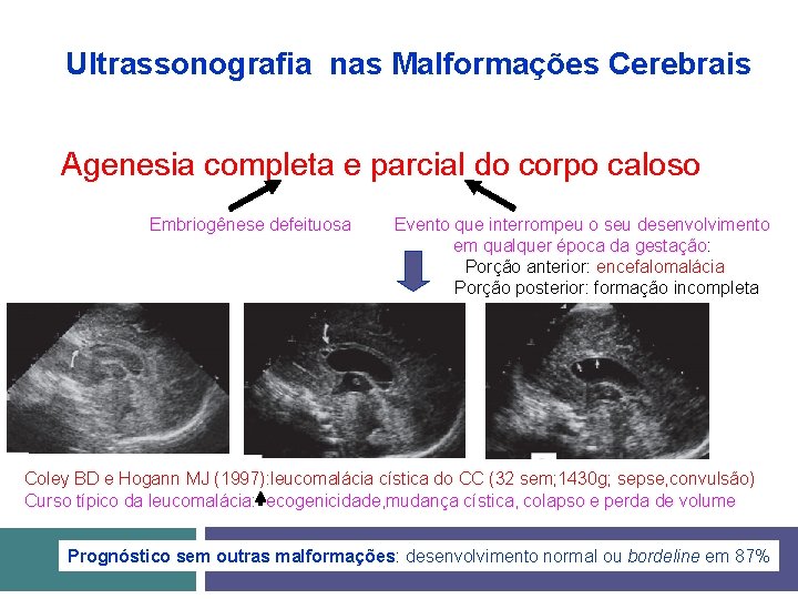 Ultrassonografia nas Malformações Cerebrais Agenesia completa e parcial do corpo caloso Embriogênese defeituosa Evento
