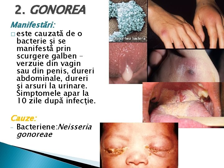 2. GONOREA Manifestări: � este cauzată de o bacterie şi se manifestă prin scurgere