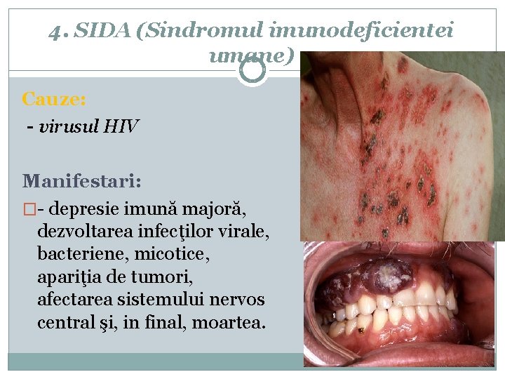 4. SIDA (Sindromul imunodeficientei umane) Cauze: - virusul HIV Manifestari: �- depresie imună majoră,