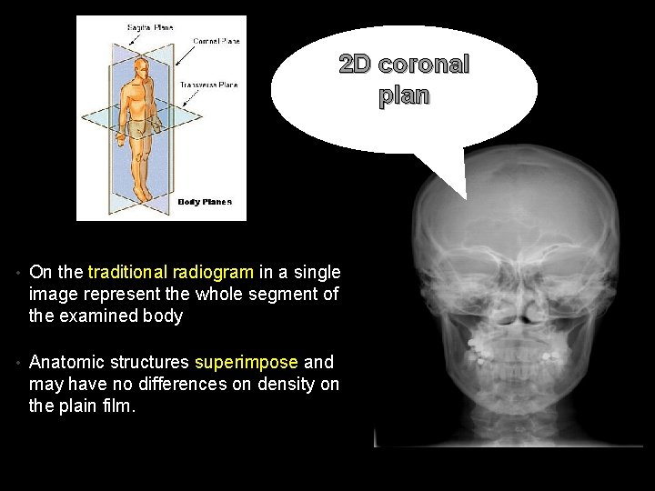 2 D coronal plan • On the traditional radiogram in a single image represent