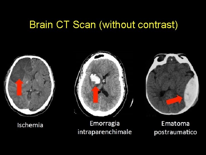 Brain CT Scan (without contrast) 