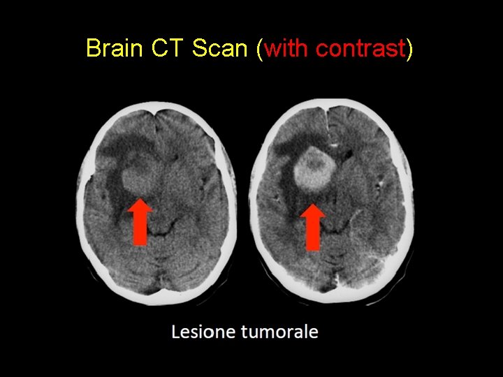 Brain CT Scan (with contrast) 