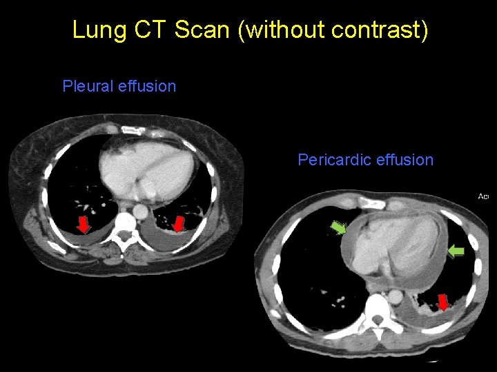 Lung CT Scan (without contrast) Pleural effusion Pericardic effusion 