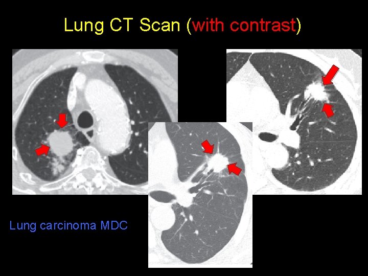 Lung CT Scan (with contrast) Lung carcinoma MDC 