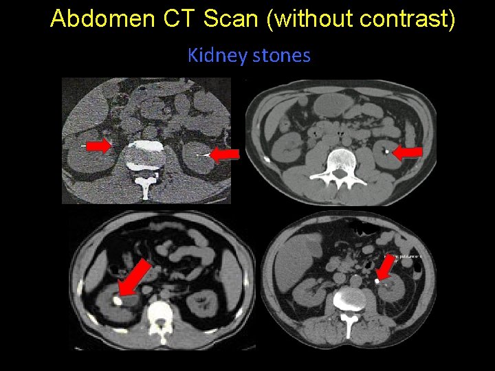 Abdomen CT Scan (without contrast) Kidney stones 