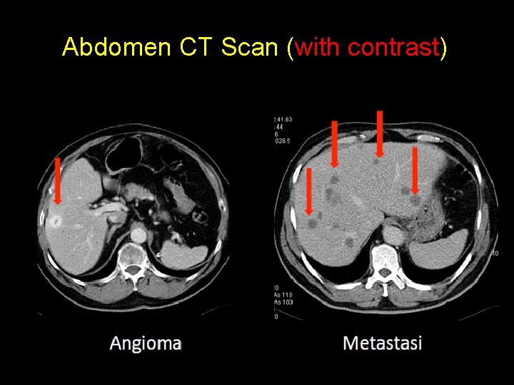 Abdomen CT Scan (with contrast) 