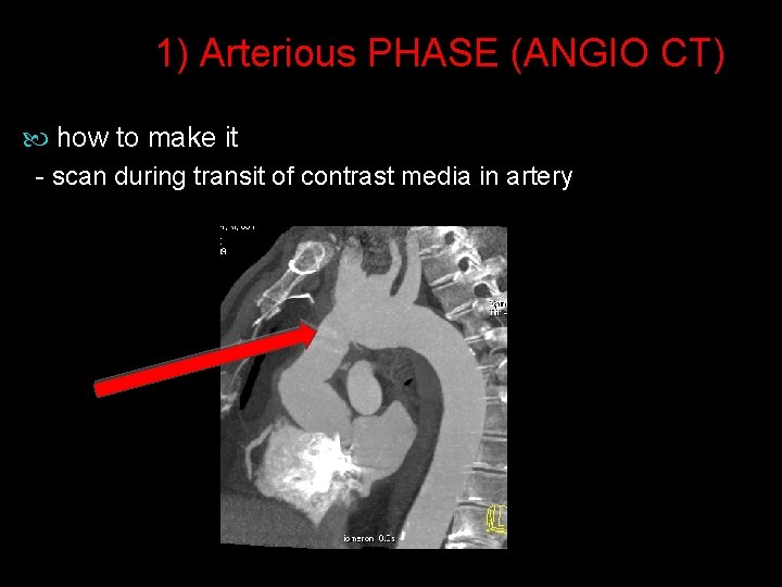 1) Arterious PHASE (ANGIO CT) how to make it - scan during transit of