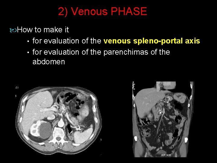2) Venous PHASE How to make it • for evaluation of the venous spleno-portal