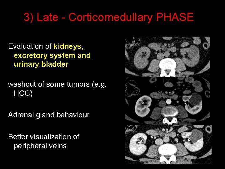 3) Late - Corticomedullary PHASE Evaluation of kidneys, excretory system and urinary bladder washout