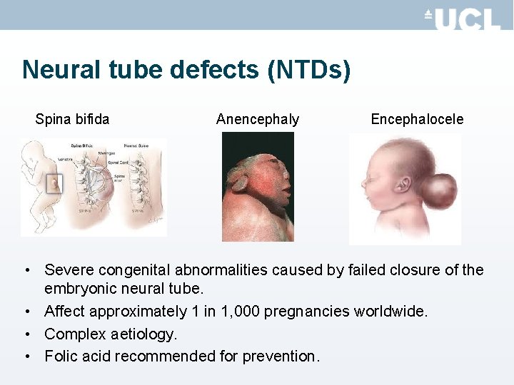 Neural tube defects (NTDs) Spina bifida Anencephaly Encephalocele • Severe congenital abnormalities caused by