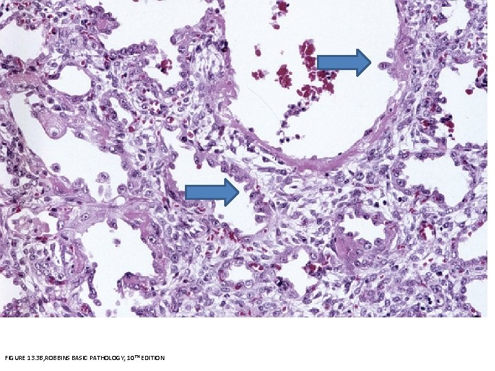 FIGURE 13. 3 B, ROBBINS BASIC PATHOLOGY, 10 TH EDITION 
