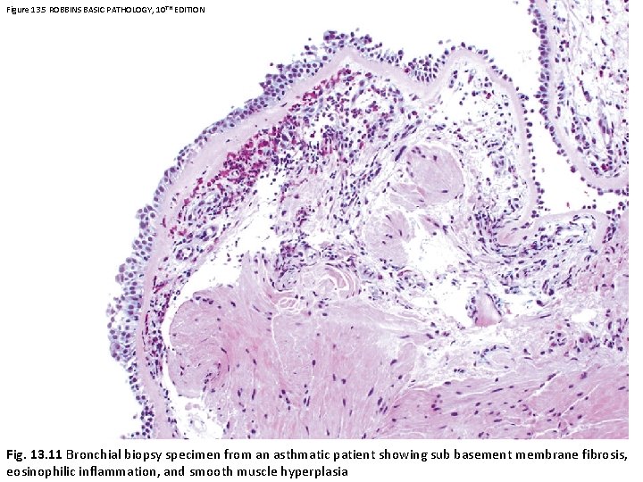 Figure 13. 5 ROBBINS BASIC PATHOLOGY, 10 TH EDITION Fig. 13. 11 Bronchial biopsy