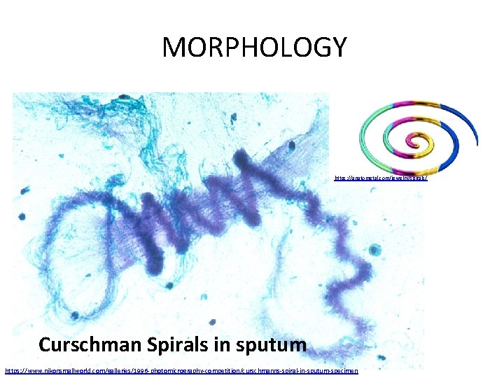 MORPHOLOGY • occlusion of bronchi and bronchioles by thick mucous plugs • mucous plugs