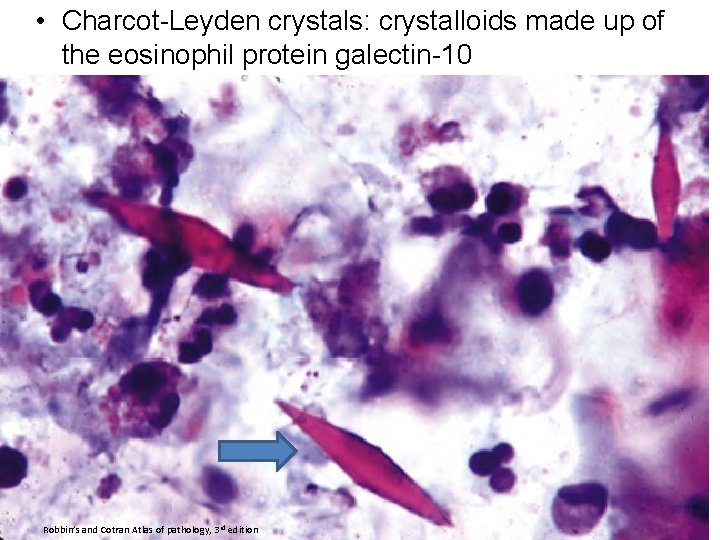  • Charcot-Leyden crystals: crystalloids made up of the eosinophil protein galectin-10 Robbin’s and