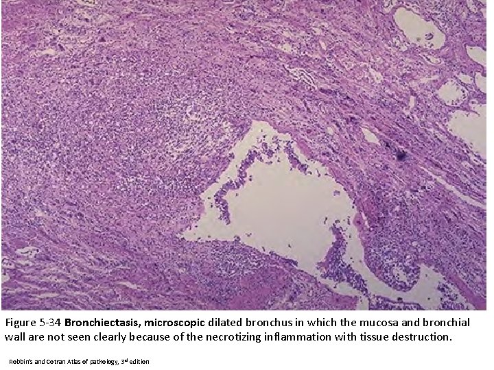 Figure 5 -34 Bronchiectasis, microscopic dilated bronchus in which the mucosa and bronchial wall