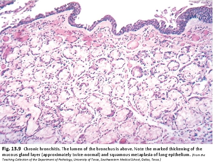 Fig. 13. 9 Chronic bronchitis. The lumen of the bronchus is above. Note the