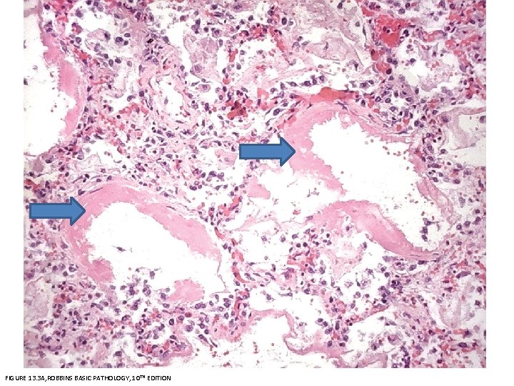 FIGURE 13. 3 A, ROBBINS BASIC PATHOLOGY, 10 TH EDITION 