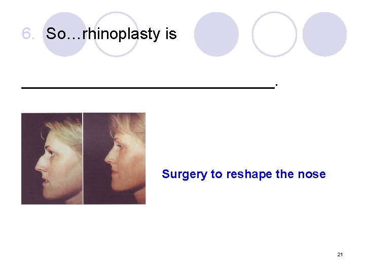 6. So…rhinoplasty is ______________. Surgery to reshape the nose 21 