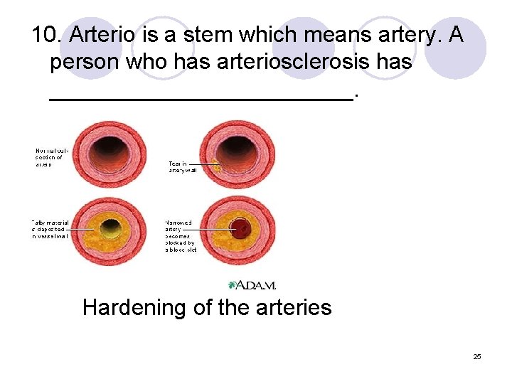 10. Arterio is a stem which means artery. A person who has arteriosclerosis has