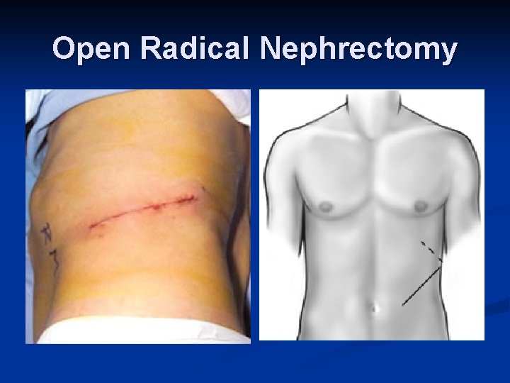Open Radical Nephrectomy 