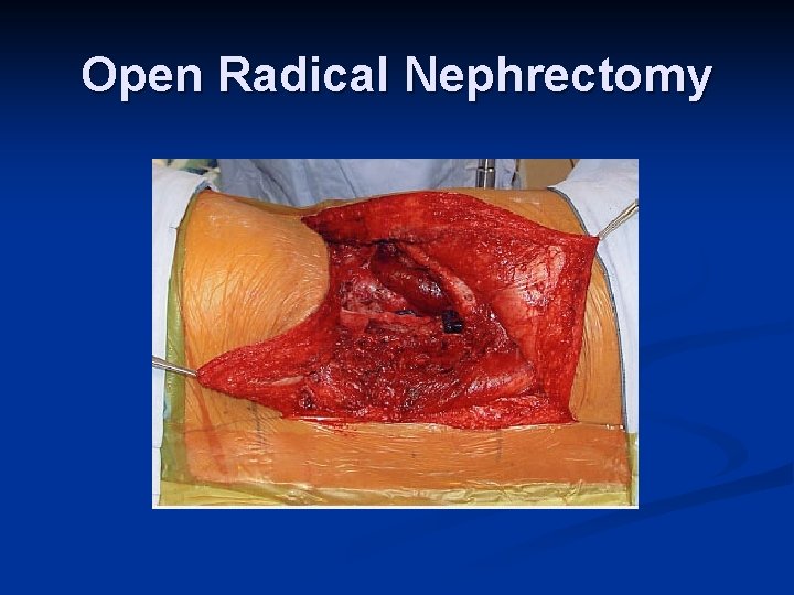 Open Radical Nephrectomy 