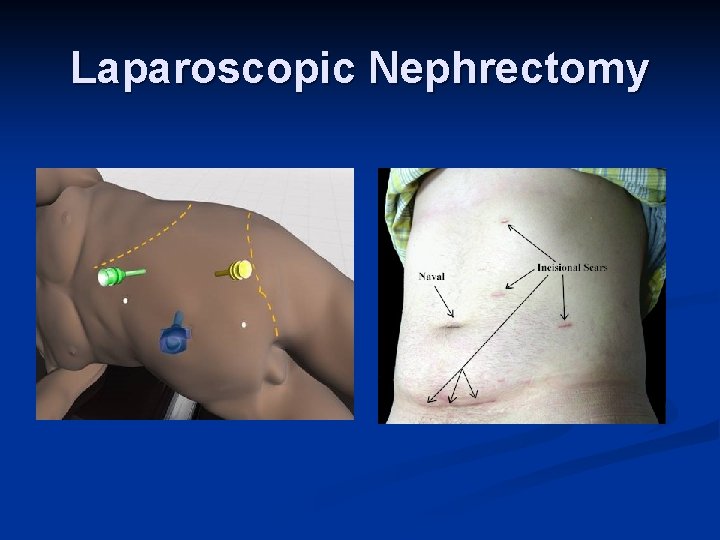 Laparoscopic Nephrectomy 