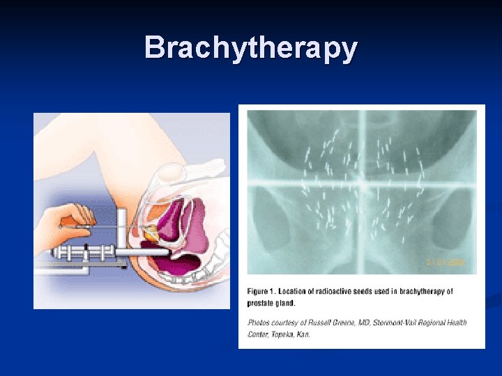 Brachytherapy 